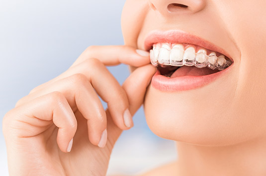 Get a Beautiful Smile With Invisalign